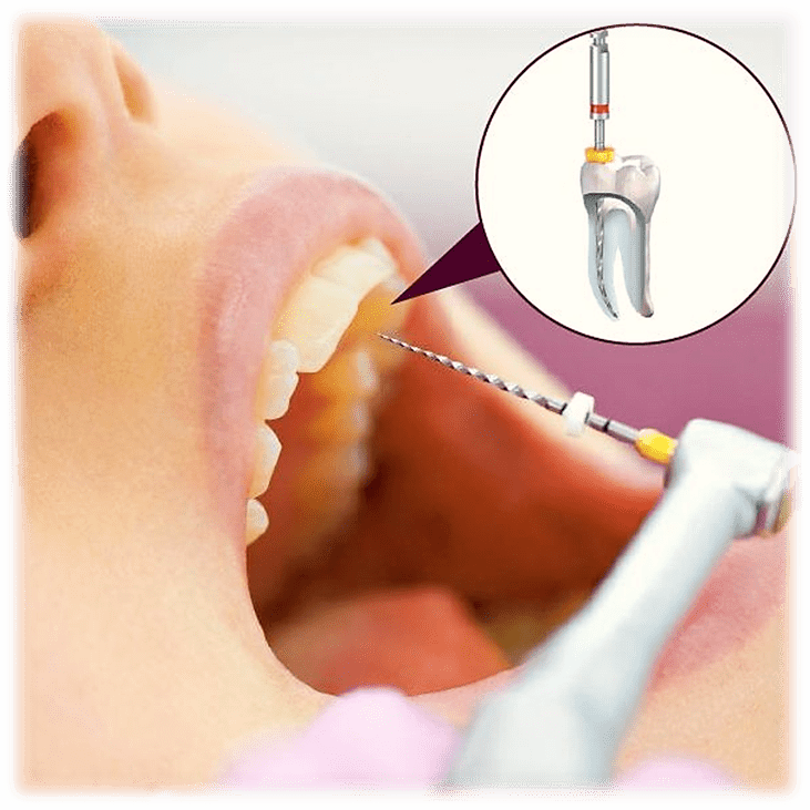 انواع دستگاه روتاری برای عصب کشی دندان